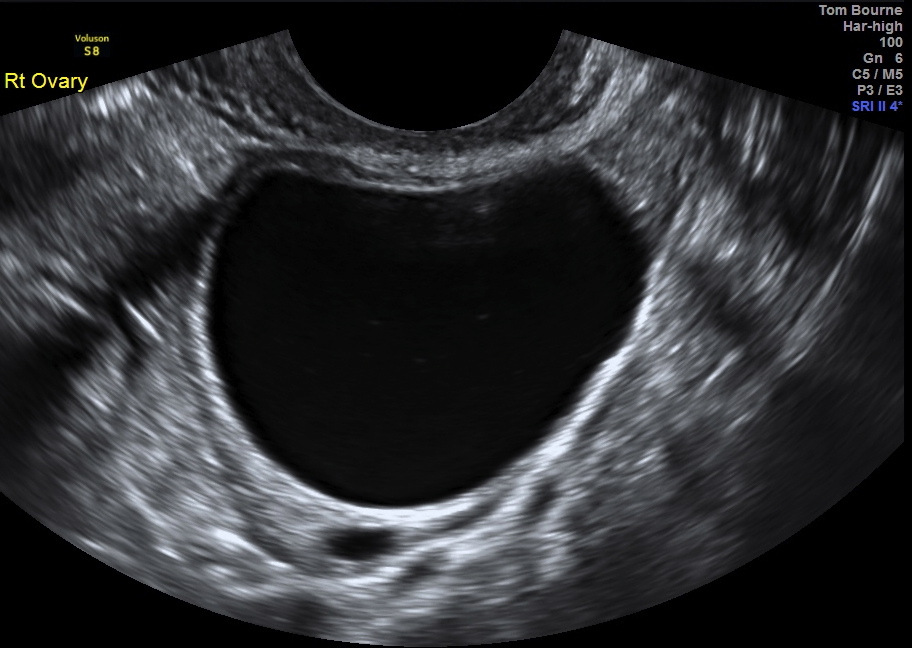 unilocular cyst2