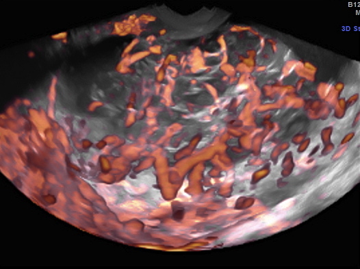 INTESTINAL MUCINOUS BORDERLINE IN PREGNANCY_22